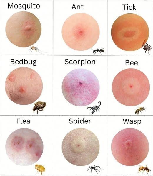 Different Bug Bites